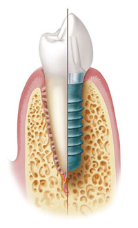 Zahn und Implantat. © Institut Straumann AG, 2013. Alle Rechte vorbehalten. Mit freundlicher Genehmigung der Institut Straumann AG